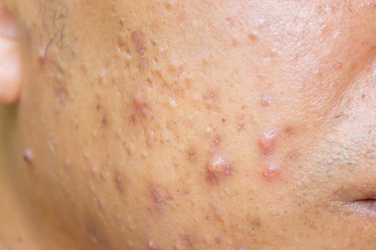 cystic acne