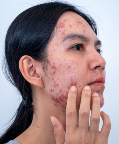  acne causing bacteria