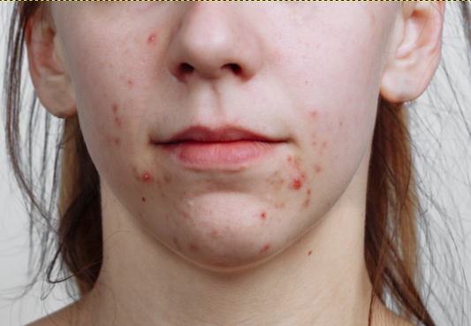 acne treatment product