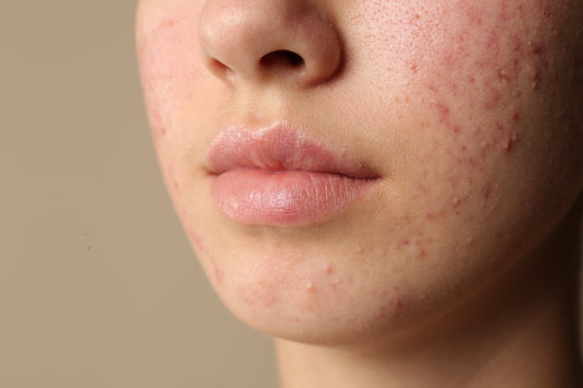natural acne treatment