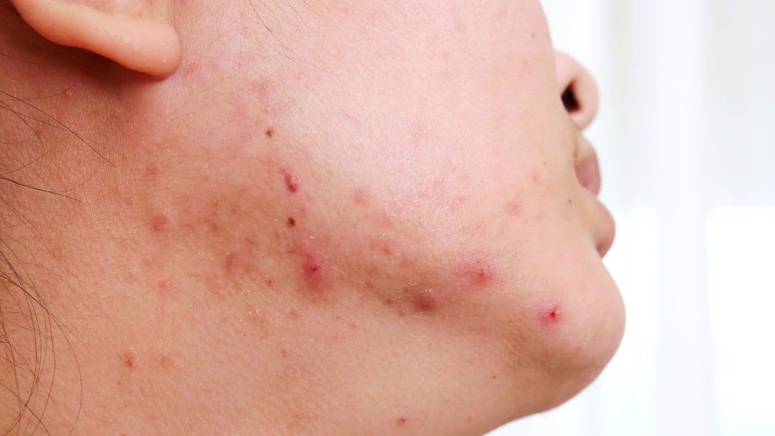 getting rid of acne