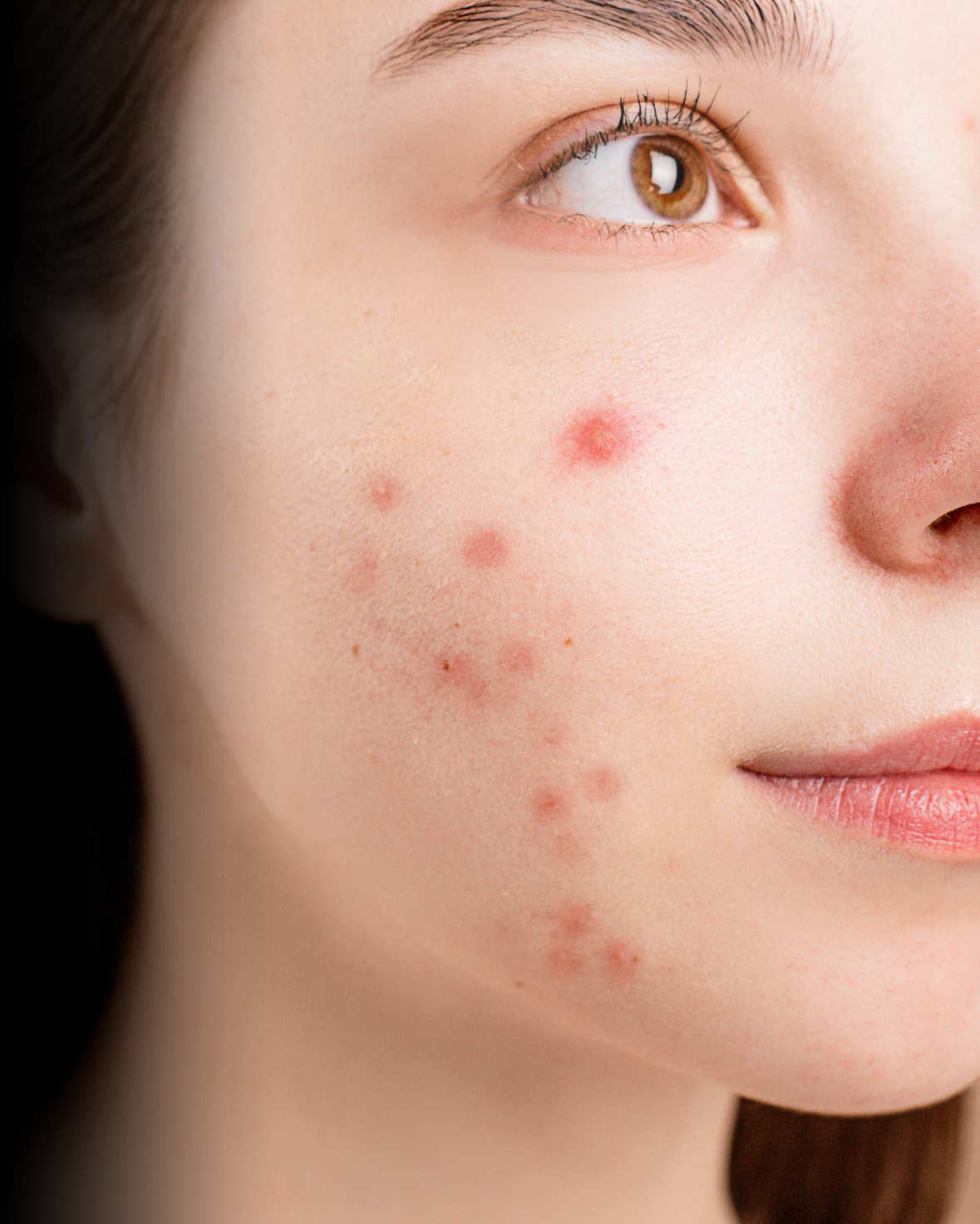 treatment for acne